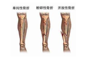 骨外科哪个医院好，中国骨外科医院排名top100