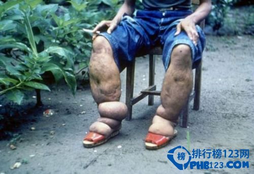 世界上最奇怪的病